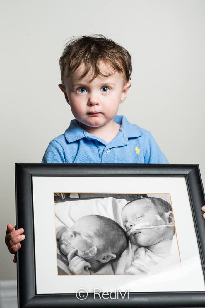 Недоношенные младенцы тогда и сейчас на фотографиях Реда Мето