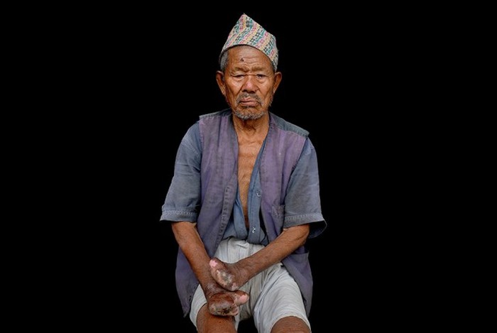 Жители колонии прокаженных в Непале