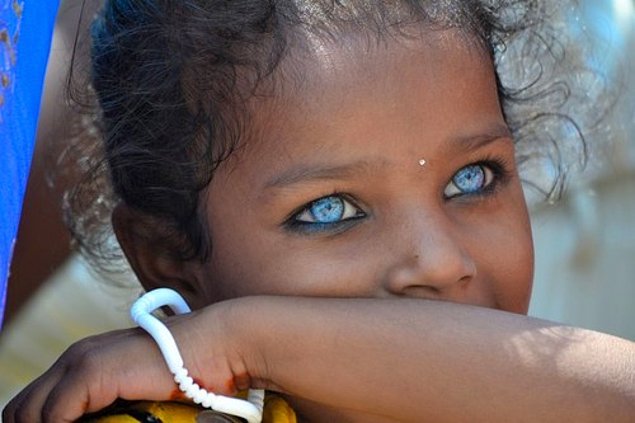 Африканские дети с голубыми глазами