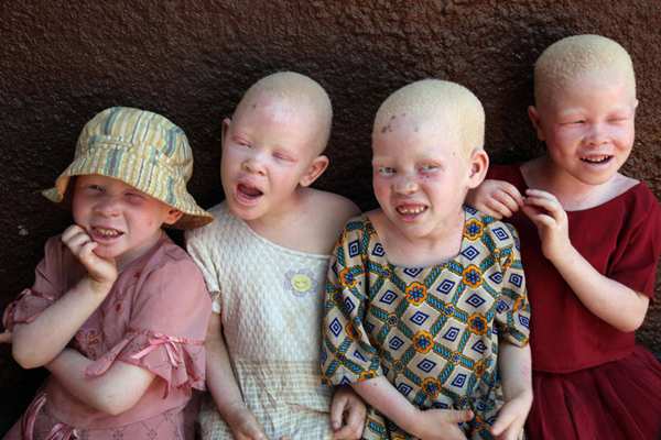 Интересные факты об альбинизме