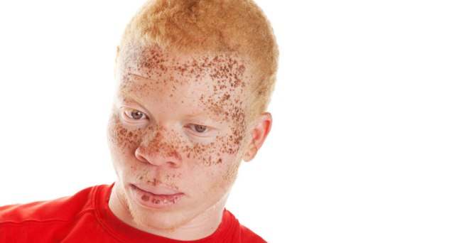 Интересные факты об альбинизме