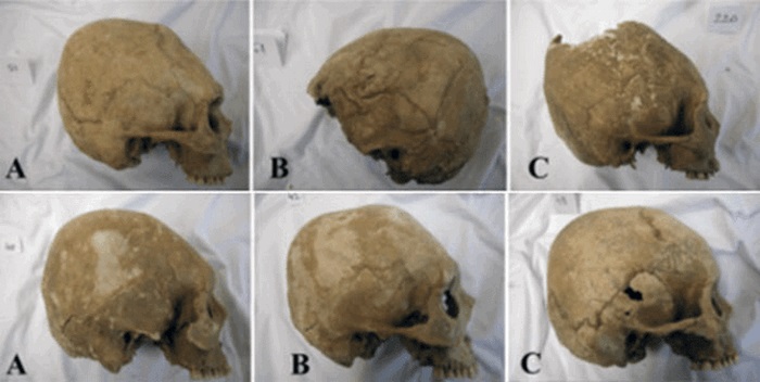 10 исторических примеров деформации черепов древними людьми
