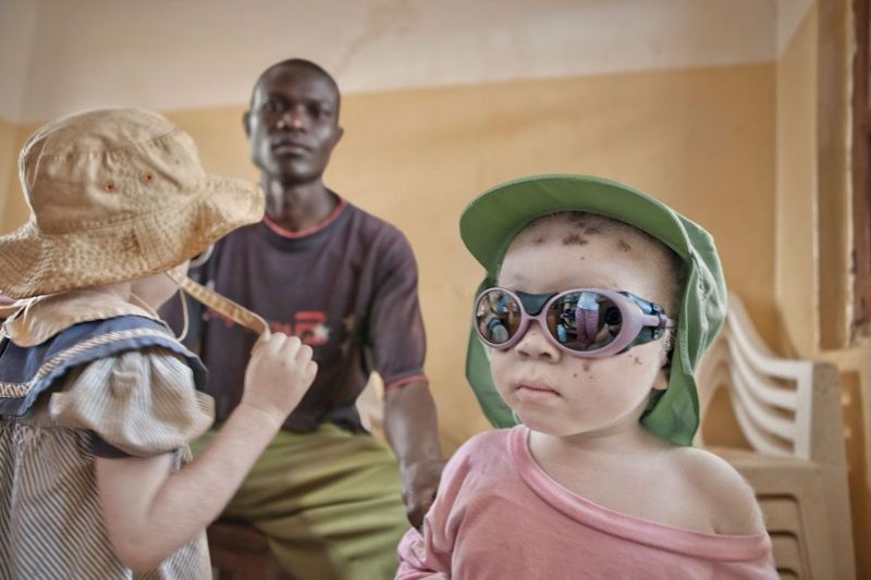 Приюты для альбиносов в Танзании защищают их от охотников на людей