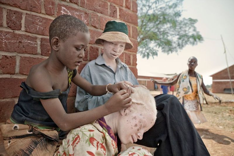 Приюты для альбиносов в Танзании защищают их от охотников на людей