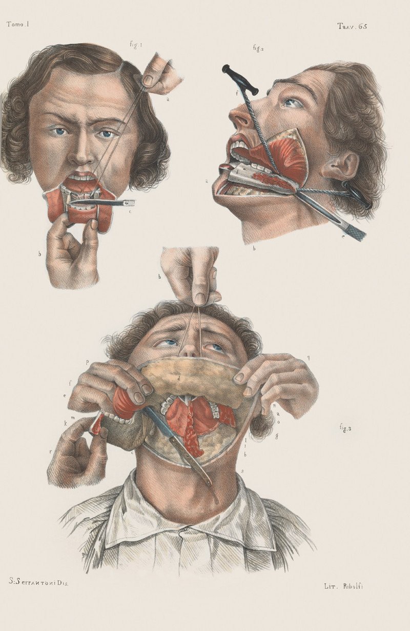 Подробные иллюстрации викторианской хирургии