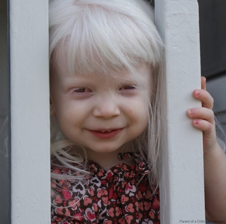 20 людей-альбиносов, поражающих своей внешностью