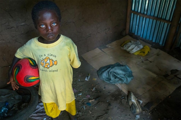 Невероятные глаза африканского мальчика, подаренные ему болезнью