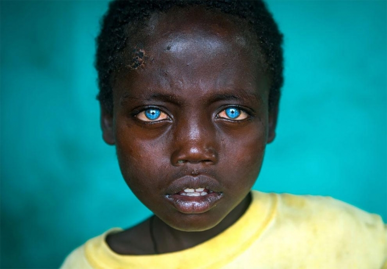 Невероятные глаза африканского мальчика, подаренные ему болезнью