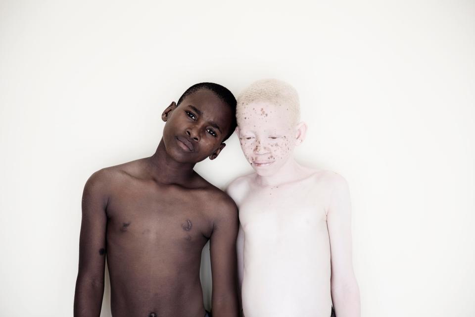 Невероятные портреты альбиносов Танзании