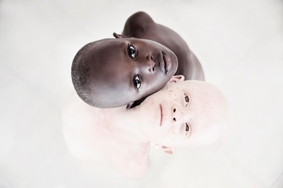 Невероятные портреты альбиносов Танзании