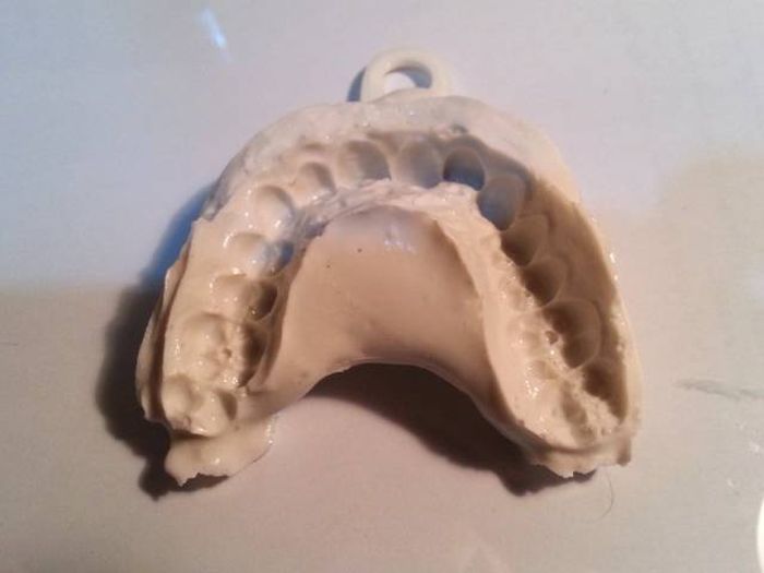 Парень выровнял зубы с помощью напечатанных на 3D-принтере брекетов