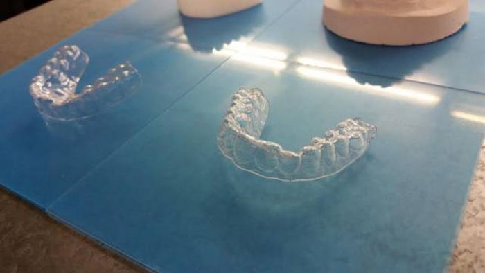 Парень выровнял зубы с помощью напечатанных на 3D-принтере брекетов