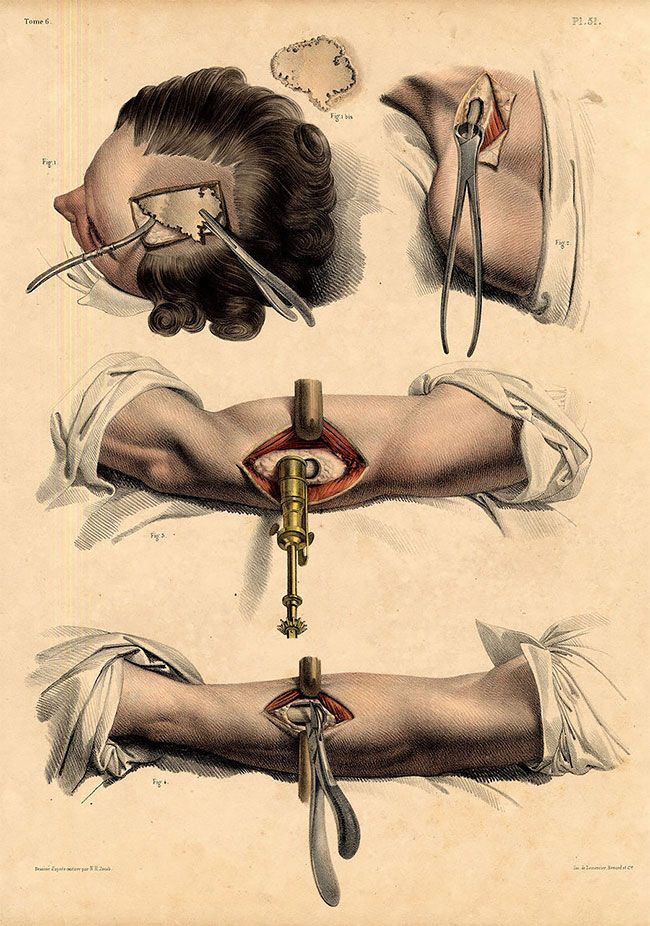 Жуткие картинки медицинских процедур начала XIX века