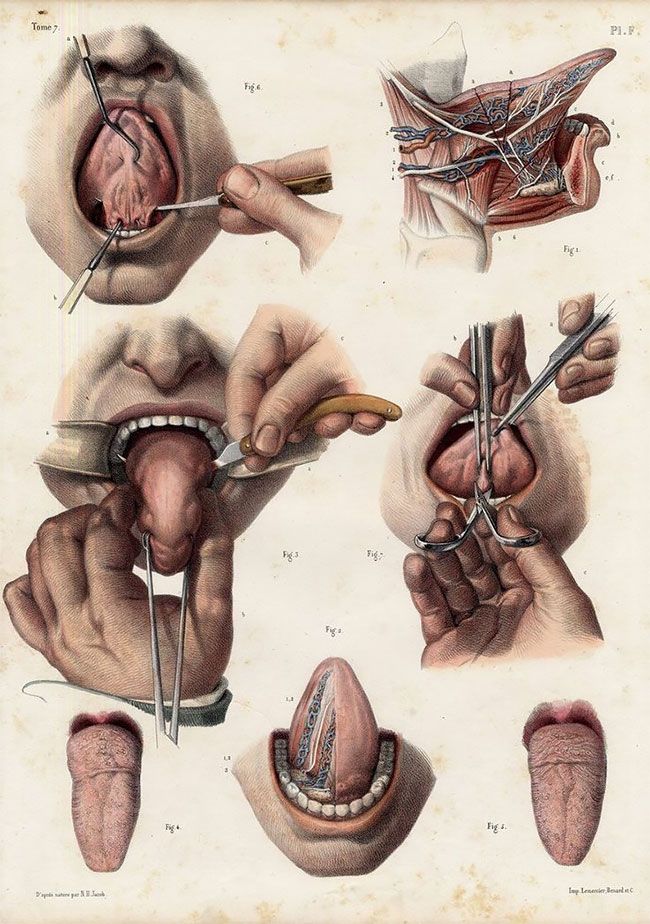 Жуткие картинки медицинских процедур начала XIX века