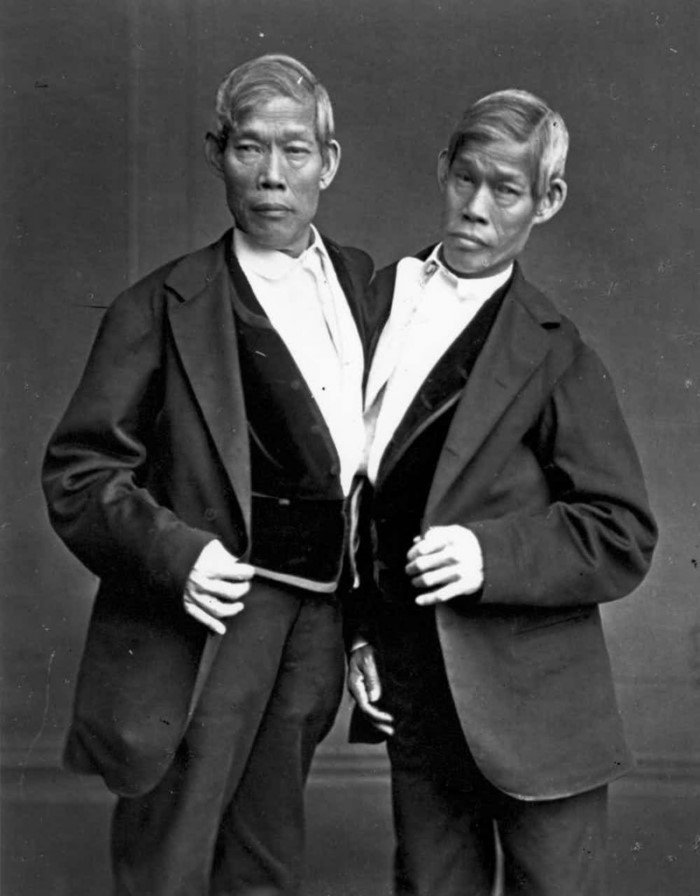 Сиамские близнецы история и фото
