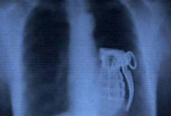 Предметы внутри тел на рентгеновских снимках