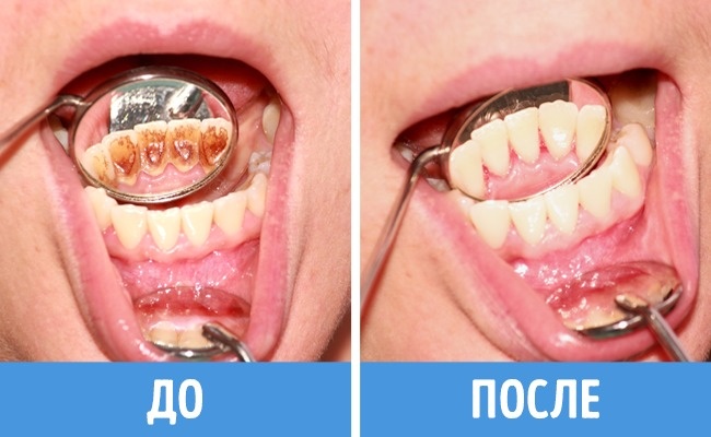 8 ошибок в уходе за зубами