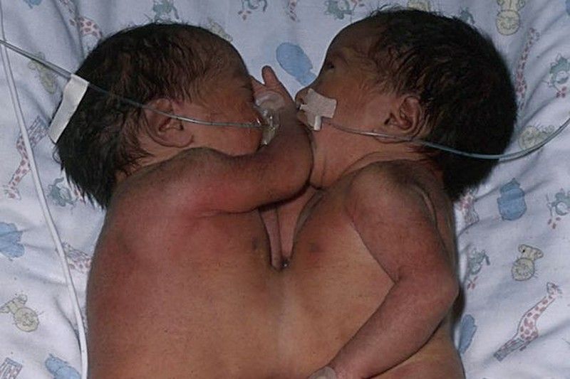 Разделенные сиамские близнецы отпраздновали 16-летие