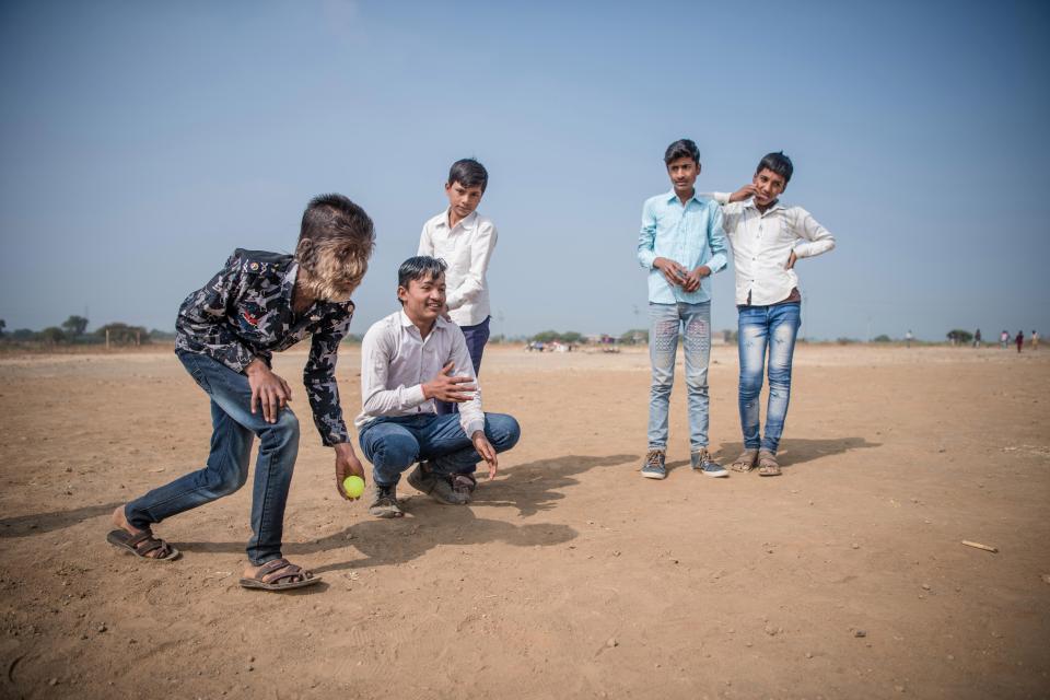 13-летний индийский мальчик с синдромом оборотня
