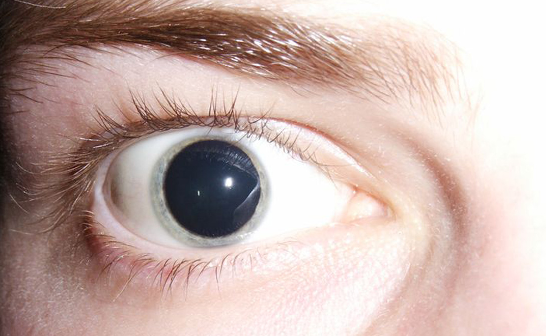 Глаза от спайса как определить что ребенок употребляет наркотики
