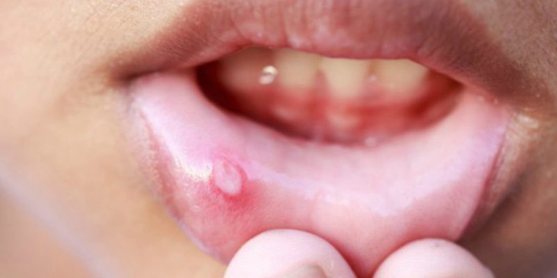 Неожиданные заболевания, которыми можно заразиться через поцелуй