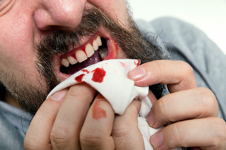 К чему может приснится выпадение зубов