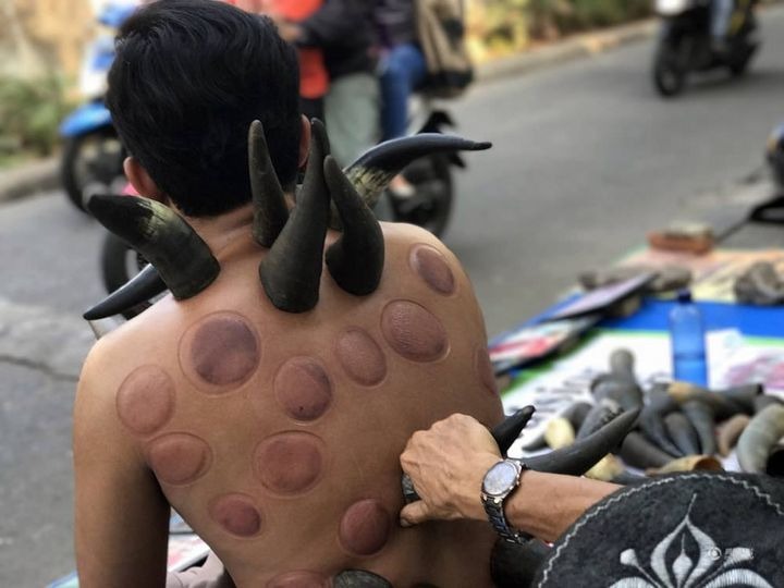 Для чего в Индонезии уличные целители ставят пациентам рога на спину