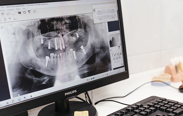 Современная классическая имплантация зубов: материалы и технологии